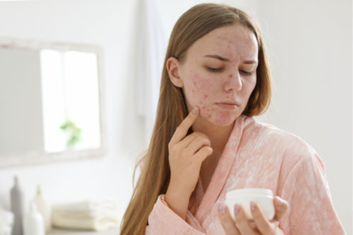 Trądzik a ajurweda: dieta i pielęgnacja skóry