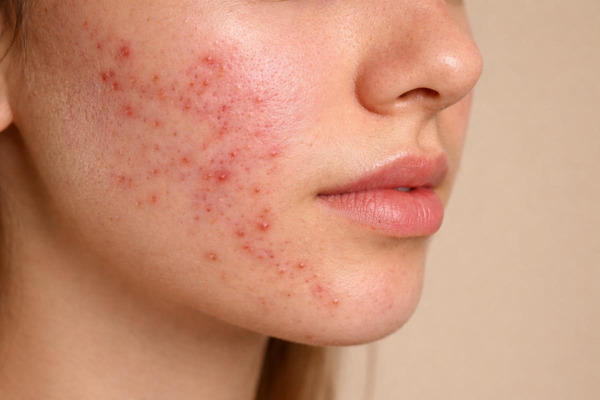Pryszcze i trądzik na brodzie – od czego powstaje?